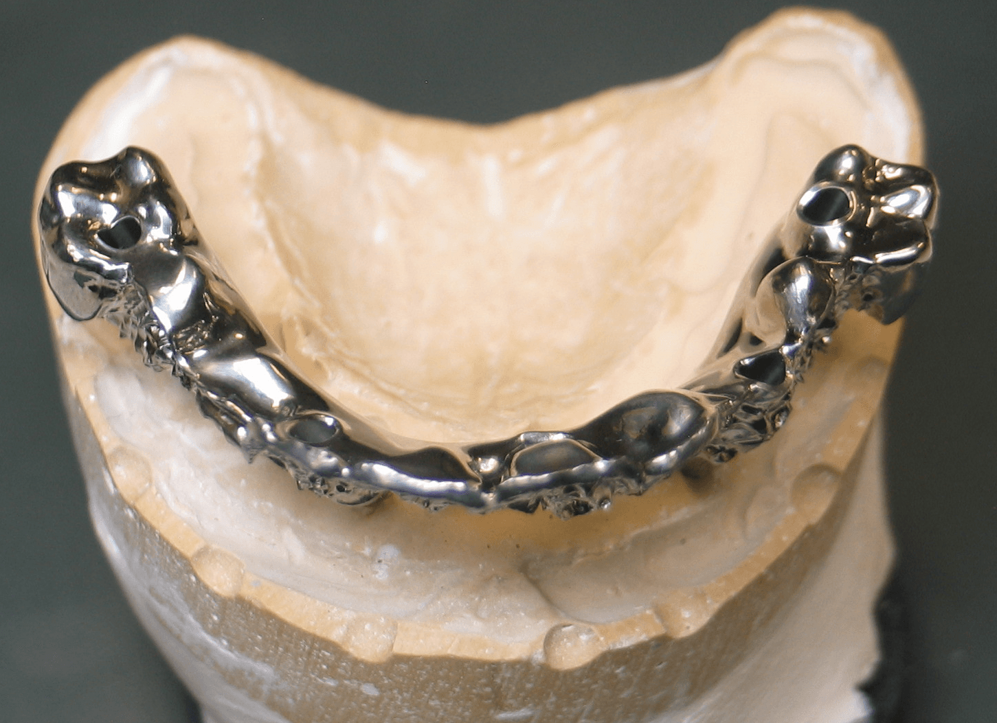 Hybrid with metal occlusion and metal linguals. 