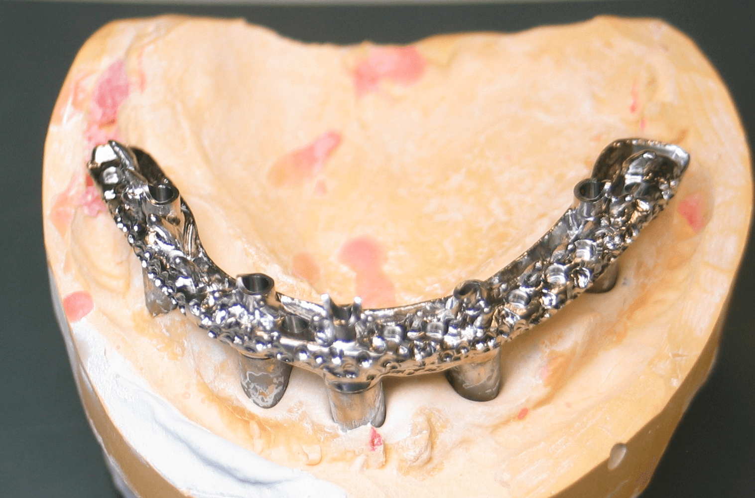 Hybrid with customized surface for mechanical retention.
