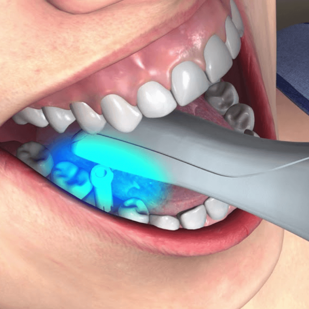 Intraoral scan