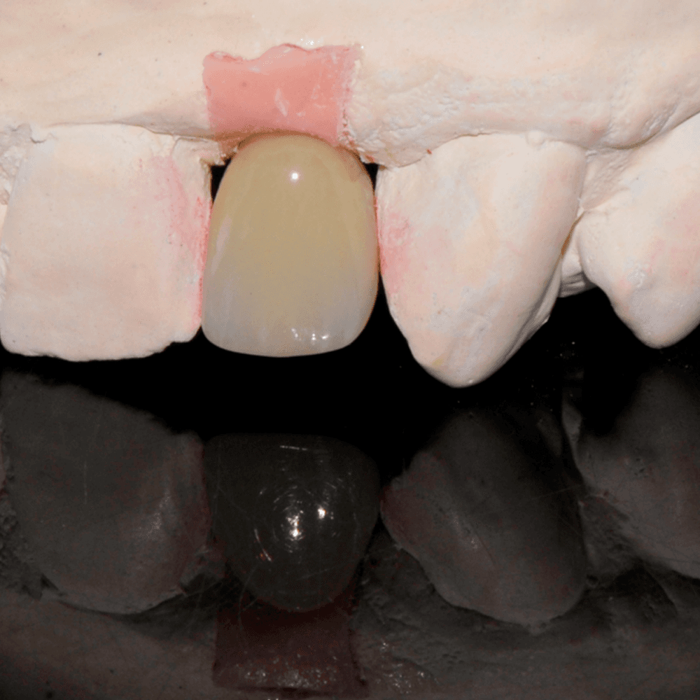 The dentist then connects the implant restoration to the implant(s) in the patient’s mouth using screw(s).