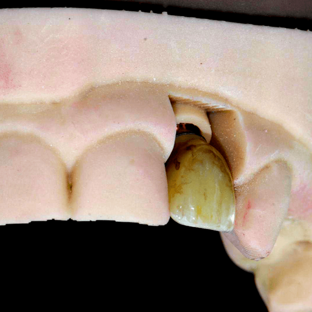 The dentist then connects the implant restoration to the implant(s) in the patient’s mouth using screw(s).