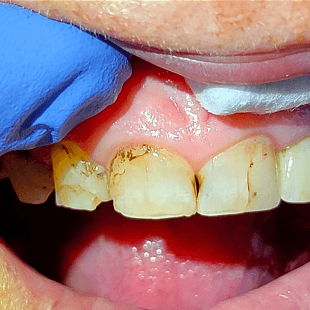 The dentist then connects the implant restoration to the implant(s) in the patient’s mouth using screw(s).