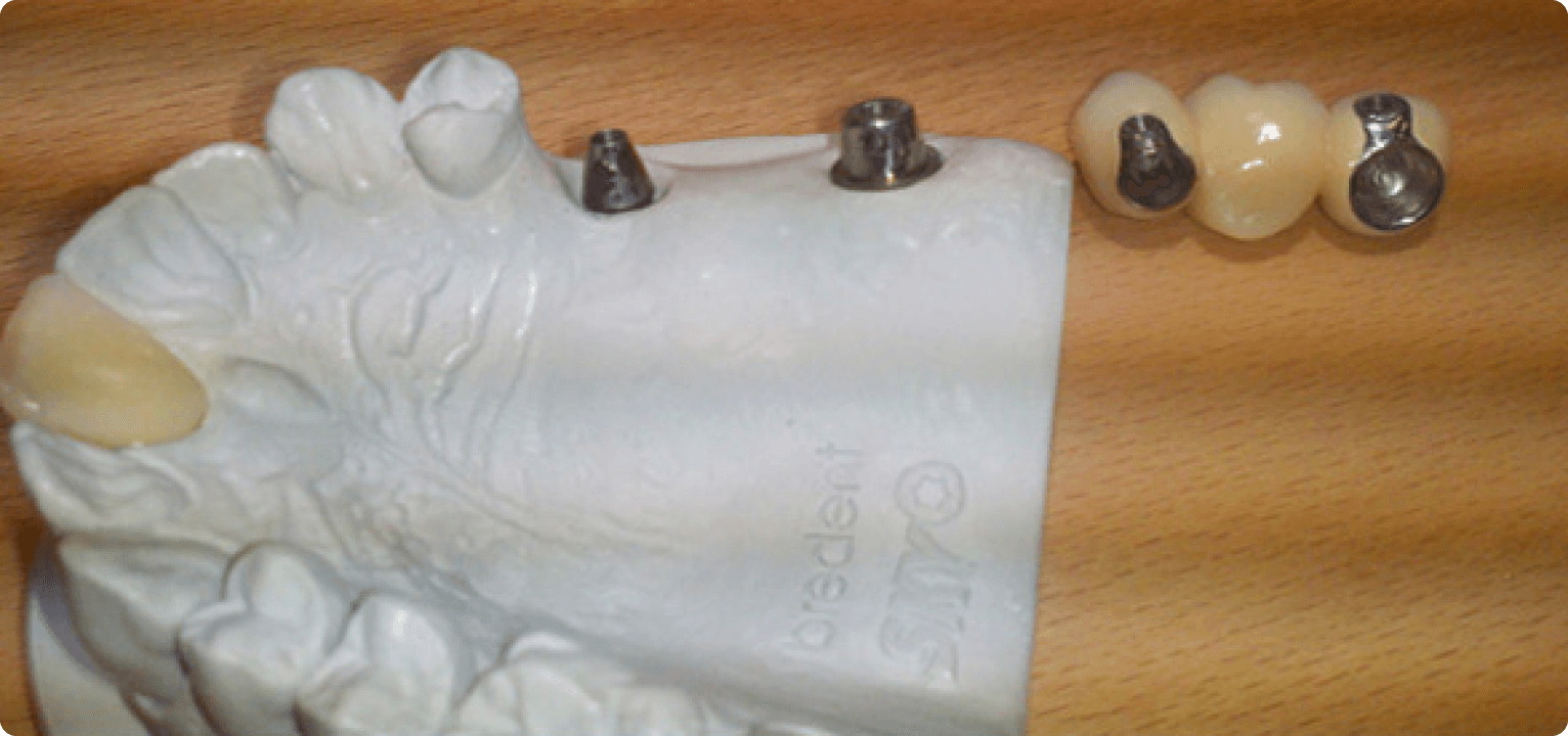 Internal Hex Tube and Screw System2