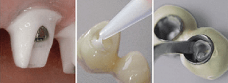 Implantlink