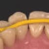 Fiber Occlusal Splinting