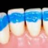 Fiber Ortho Ligual Retainer 