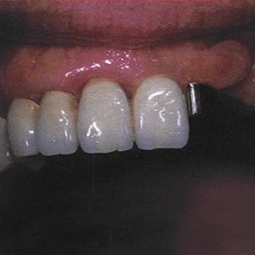 Vertix &quot;P&quot; Attachment