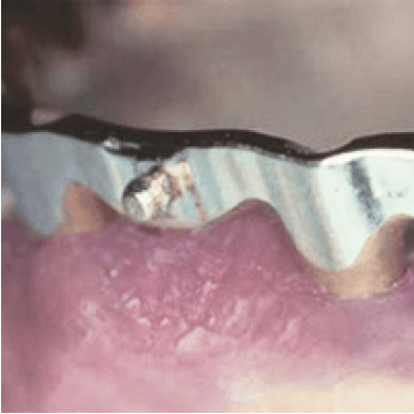 Castable Spherical Attachment