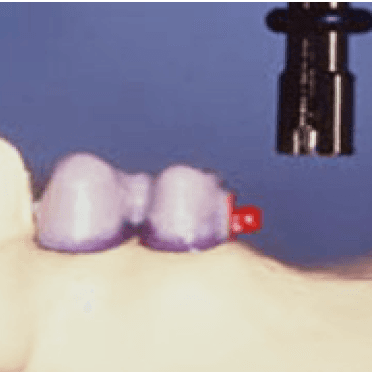 Castable Spherical Attachment