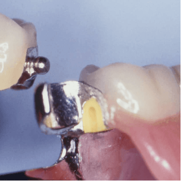 Castable Spherical Attachment