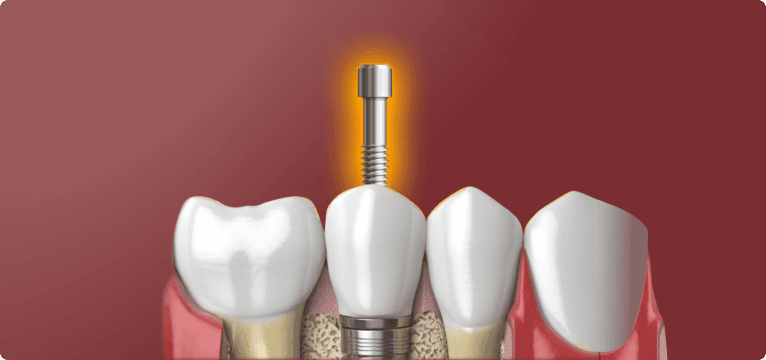 Implant Screws by Preat - Compatible with all major implant brands