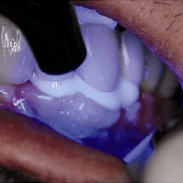 Implantlink