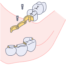 Internal Hex Tube and Screw System
