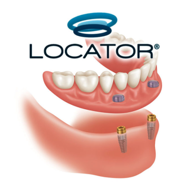 Over-Denture O-Ring and Locator Replacement Service