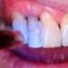 Labial Periodontal Splint