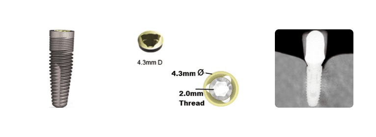 Nobel Tri-lobe RP