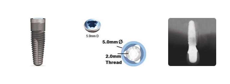 Nobel Tri-lobe WP