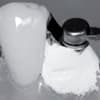 PermaBlock Procedure Insert