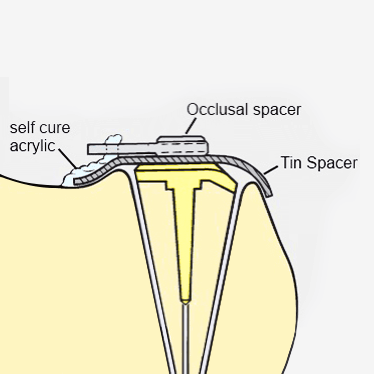 Rothermann Attachment System