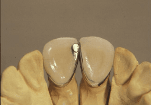 Splitastic anterior rod tube