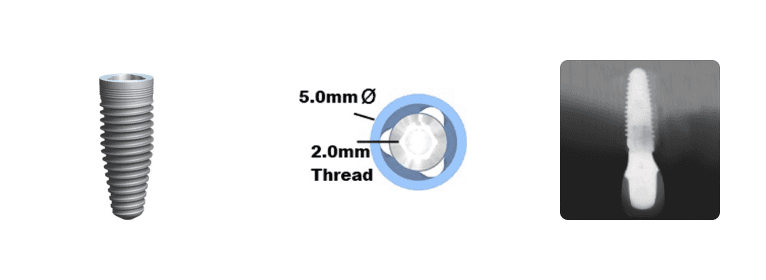 Trilobe WP 5.0mm