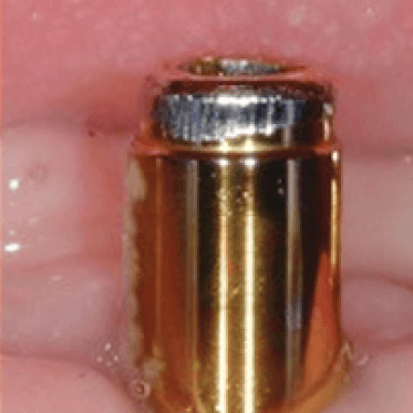 LOCATOR® Implant Attachment Specifications