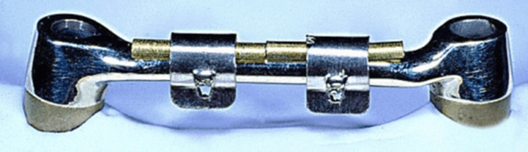The Ackermann Clip