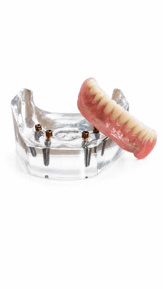 PreatLoc™ 4 Implant Patient Education Model