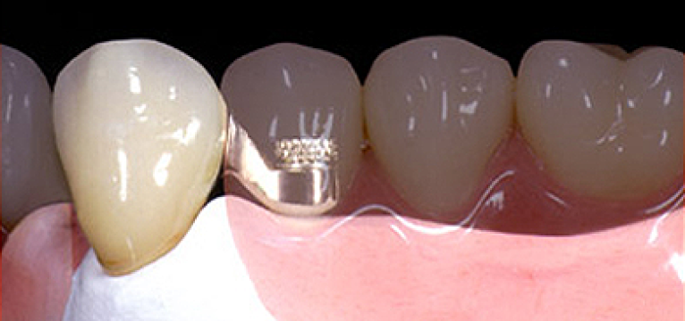Dental-Attachments-image-template