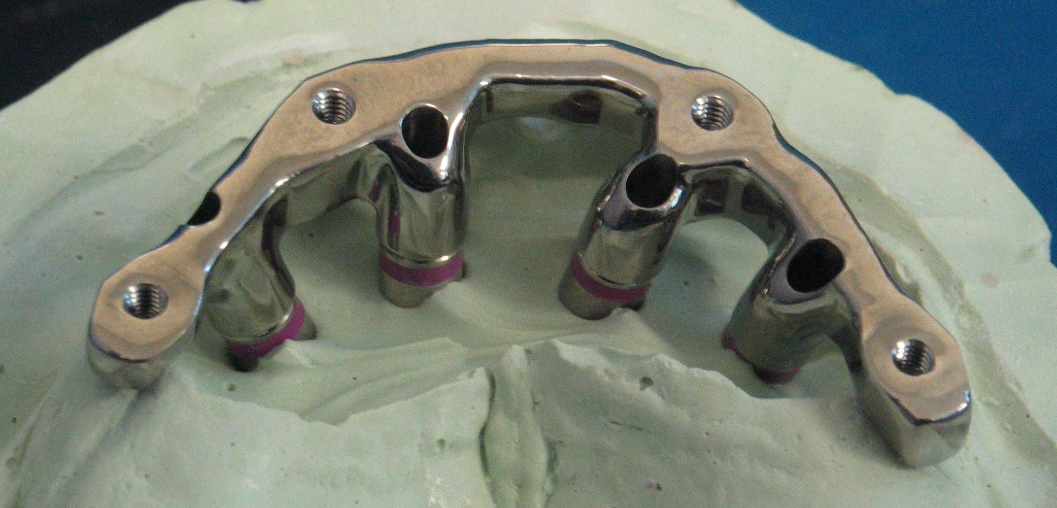 Overdenture bar for threaded Locators or Clix Attachments.