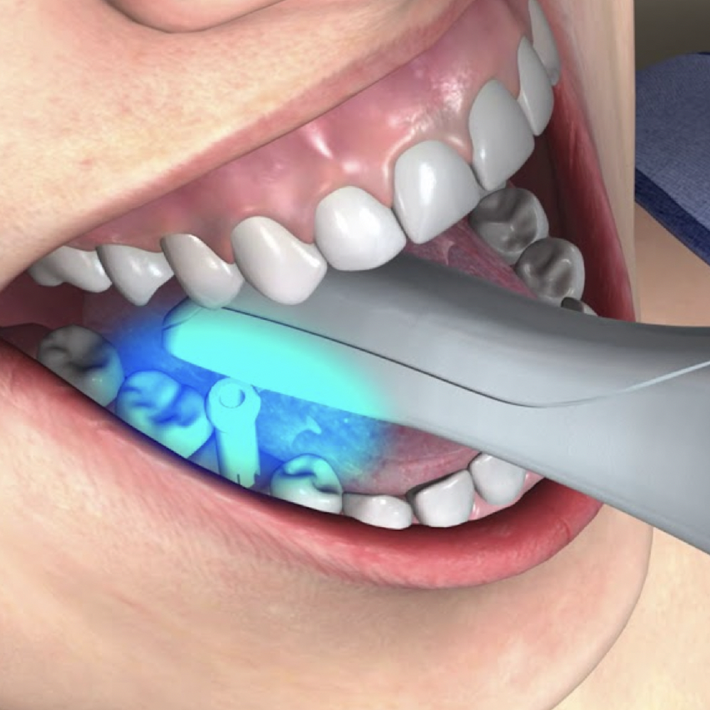Intraoral scan