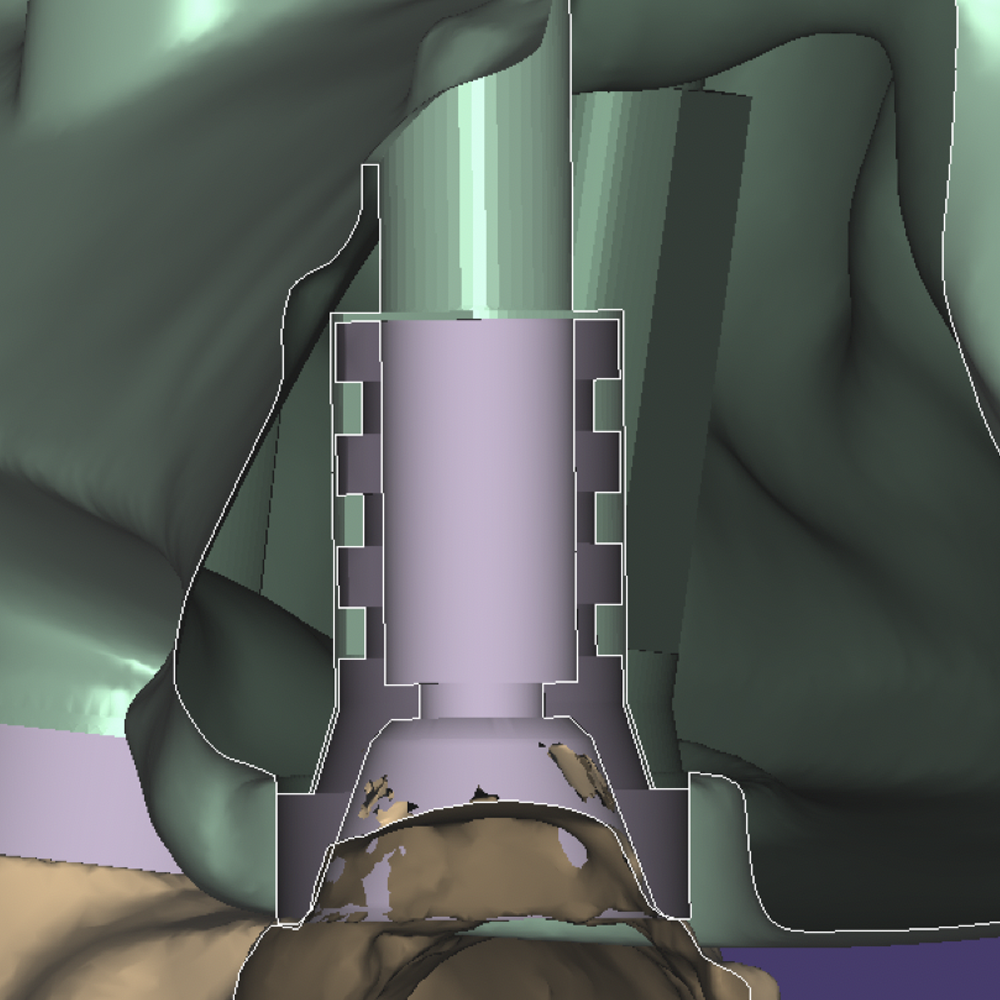 Implant connecting component