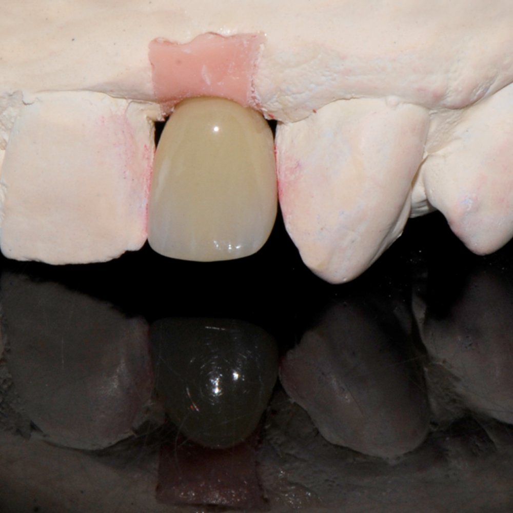 The dentist then connects the implant restoration to the implant(s) in the patient’s mouth using screw(s).