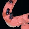 The Journal of Prosthetic Dentistry - Polishing Cap