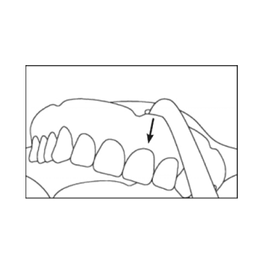 Denture Removal Tool