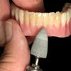 Perma Mesh Denture Repair