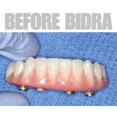 Rough areas without Bidra