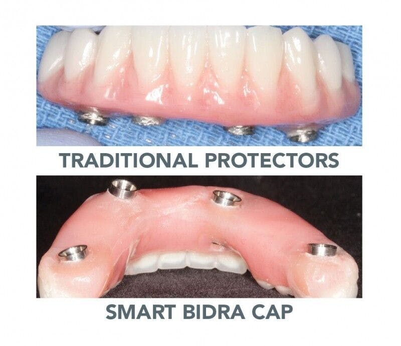 Bidra® Smart Polishing Cap Short (4-pack)